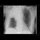 Atelectasis and tumorous infiltration of right upper lobe: X-ray - Plain radiograph
